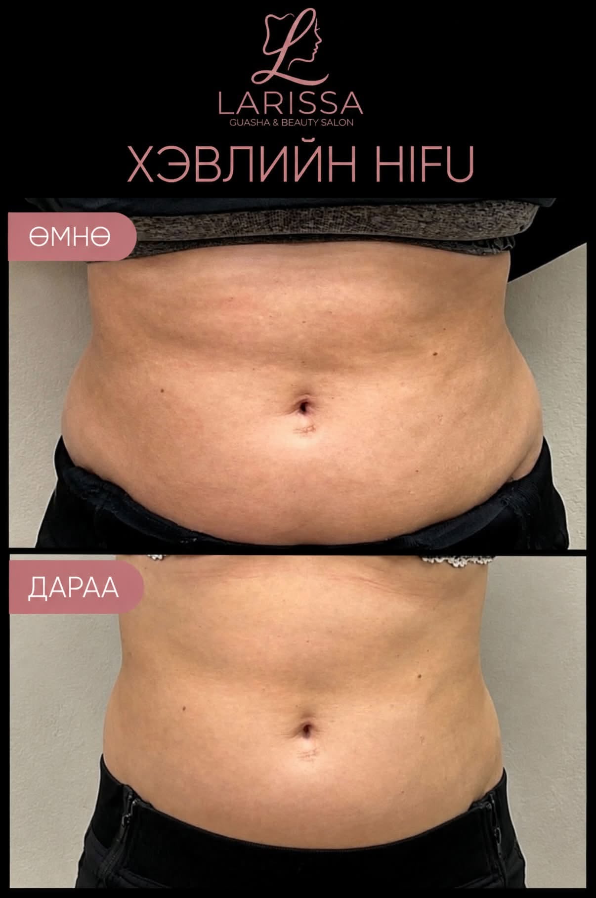 HIFU - Бие хэсэгчилсэн