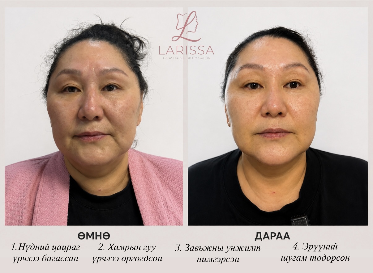 HiFU 50D — Нүүр, хүзүү